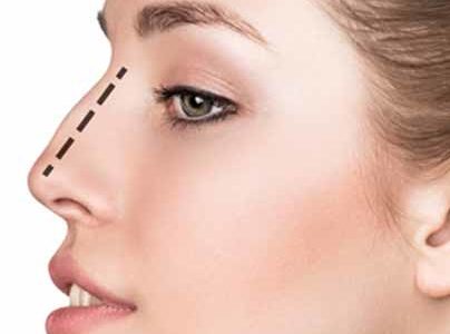 Les bénéfices d’une rhinoplastie